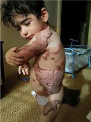 Burned Child Khan Younis